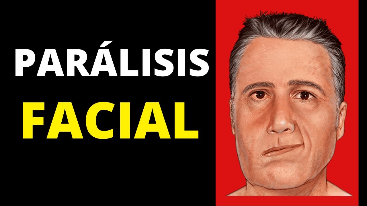 Parálisis facial: síntomas, diagnóstico, tratamiento y pronóstico