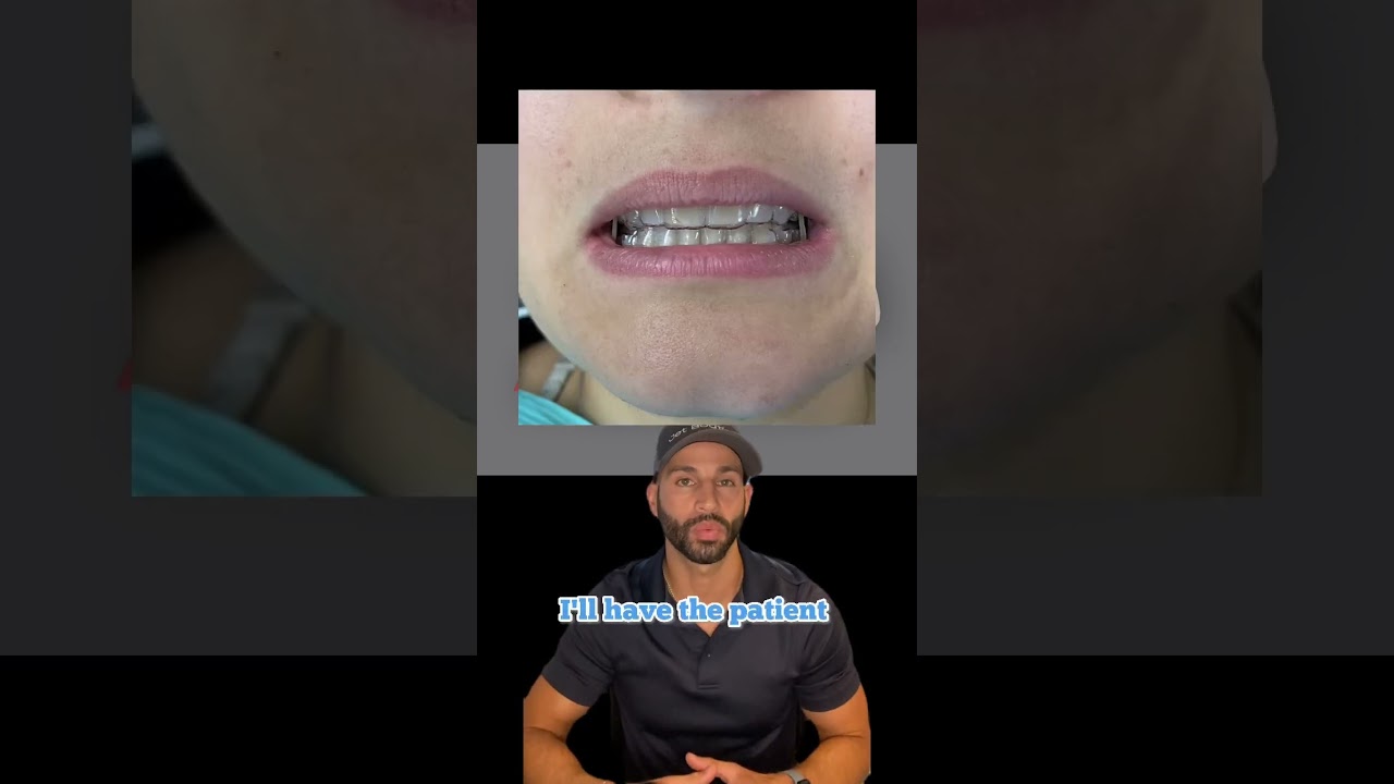 How Invisalign Works: A Case Review. 2023
