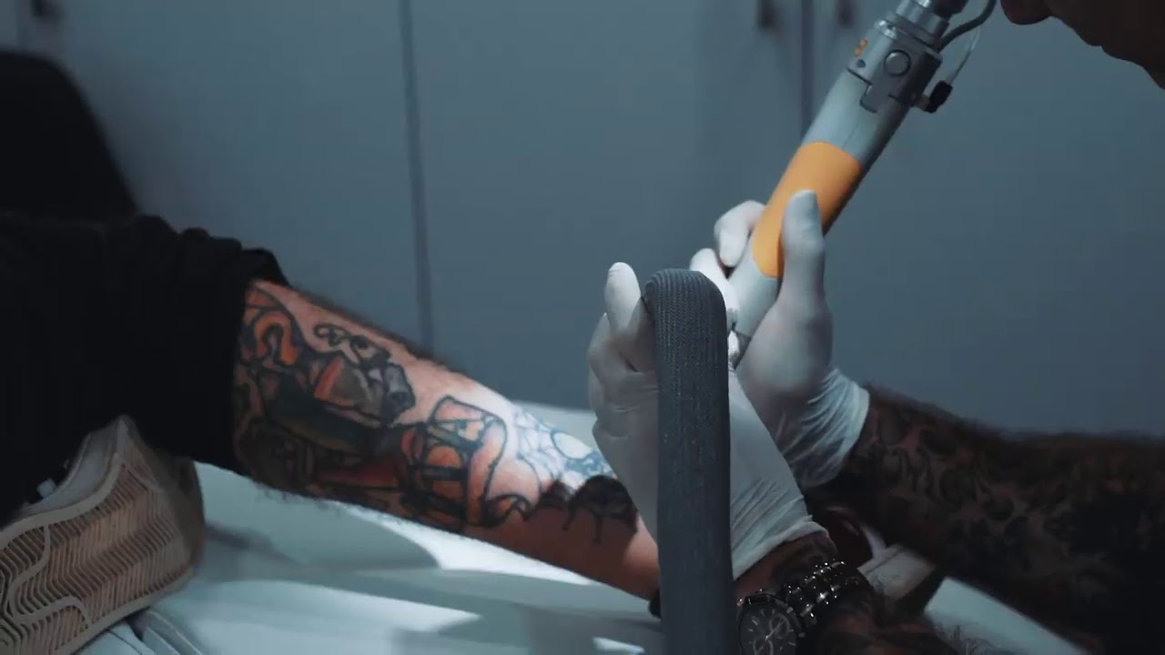 Ink Blaster | Tattoo Removal Sydney | Laser Ink Removal