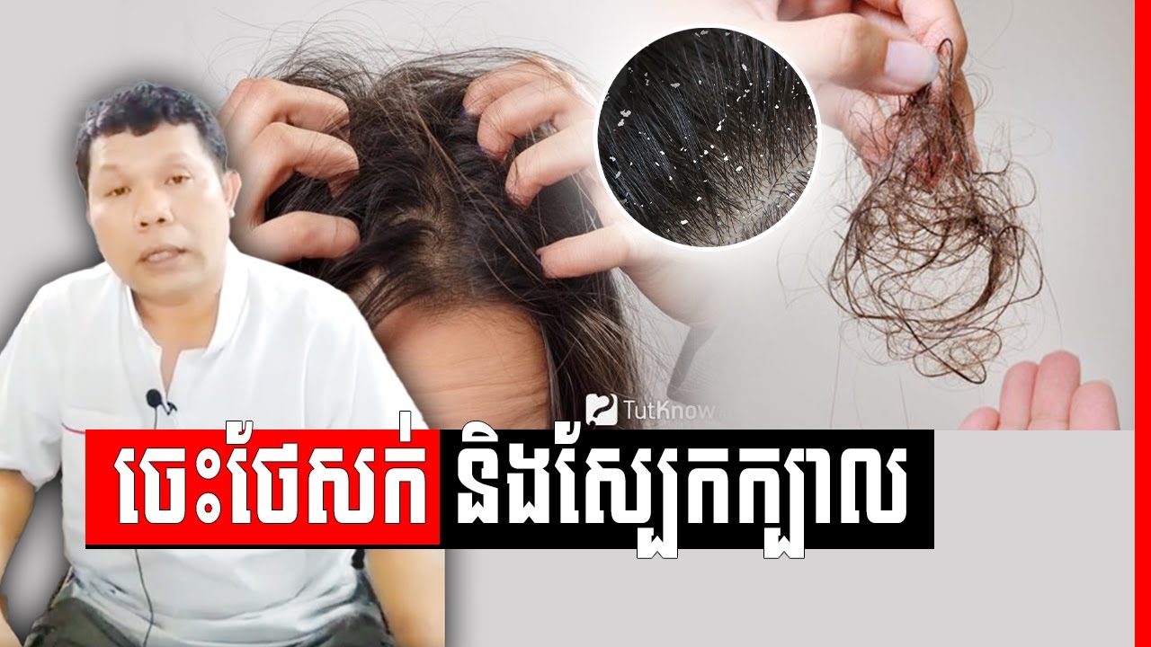 បញ្ហាសក់ និង បញ្ហាស្បែកក្បាលរលាក រមាស់ អង្គែ វេជ្ជ. ហែន ភារៈ , Hair Problem