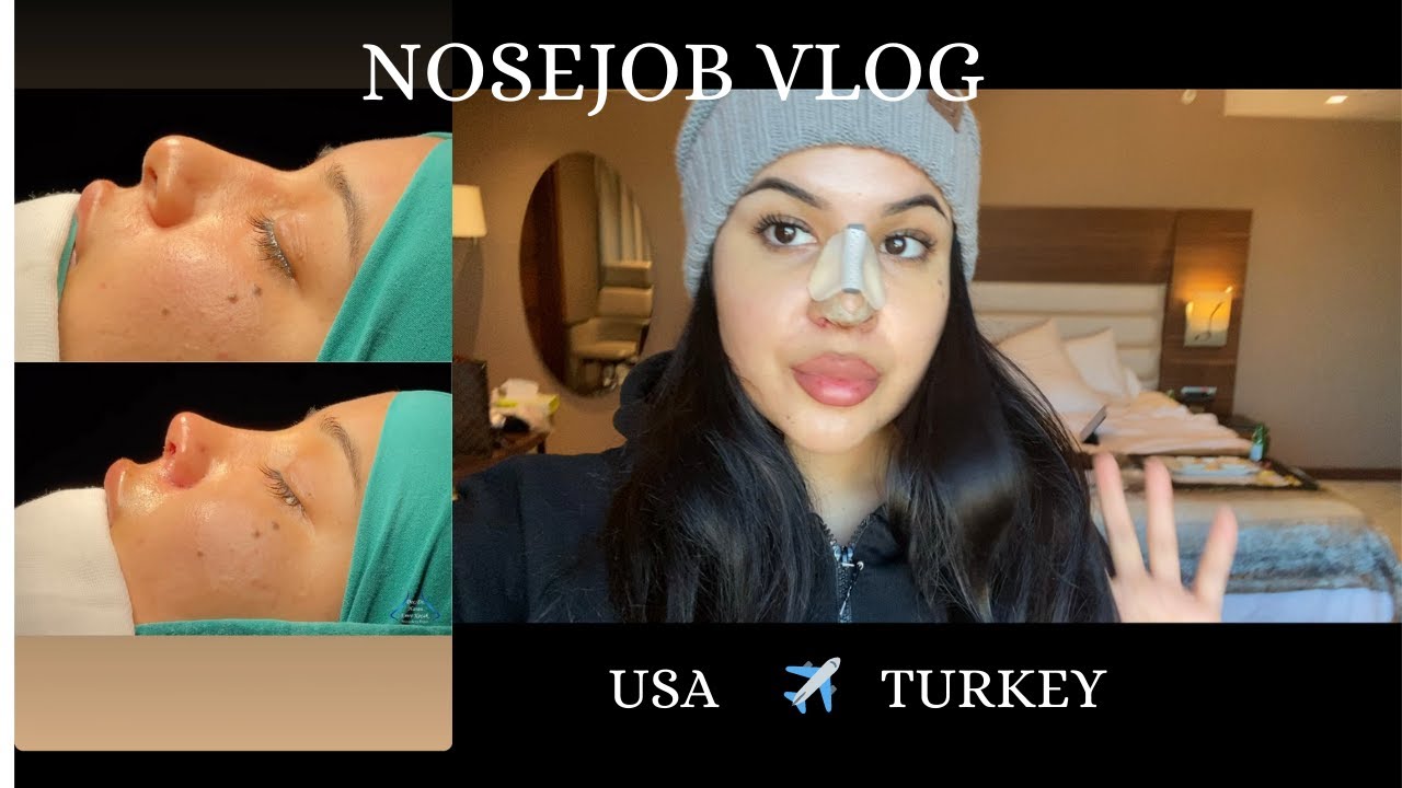 I FLEW TO TURKEY ALONE FOR A NOSEJOB! Rhinoplasty results, recovery & 2 year update