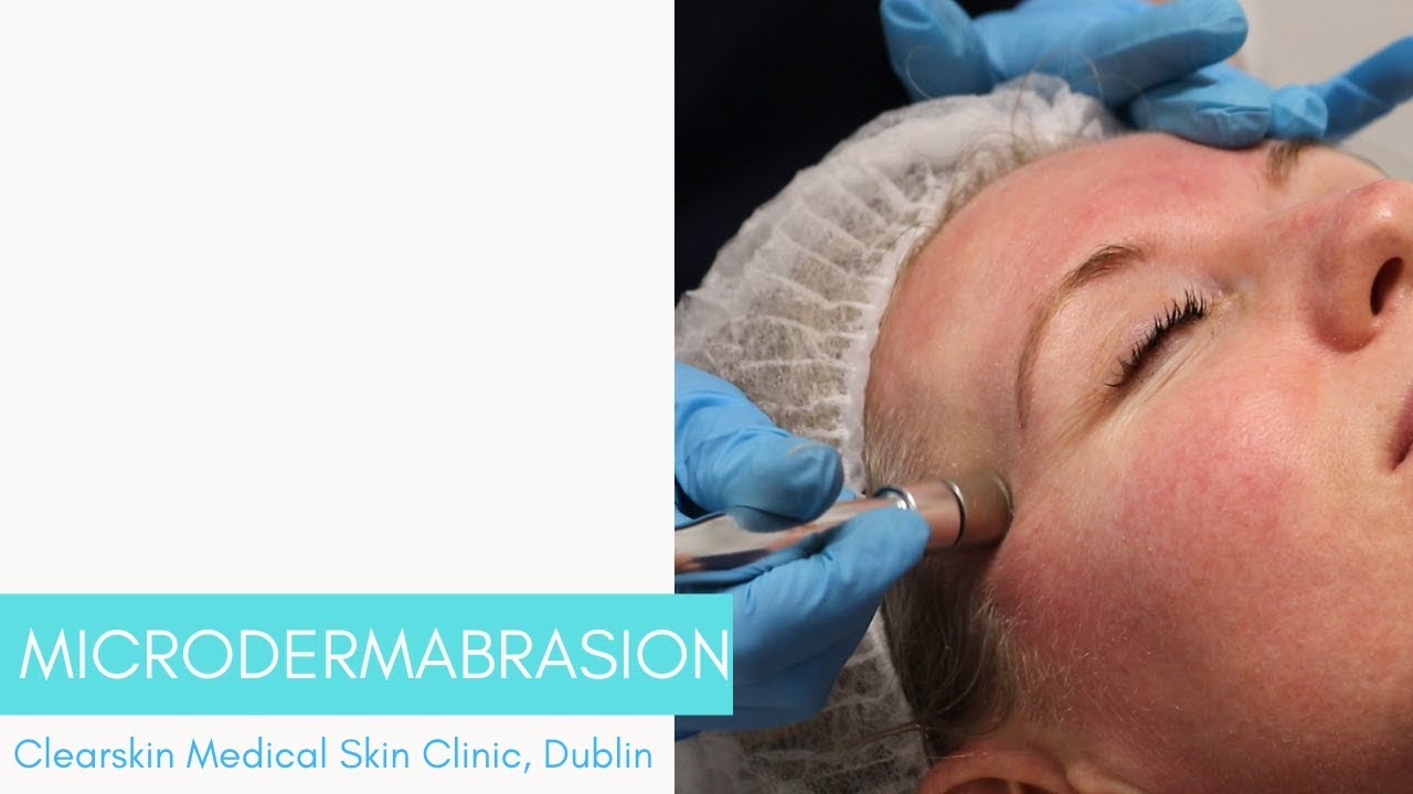 Microdermabrasion | Clearskin Clinic Dublin