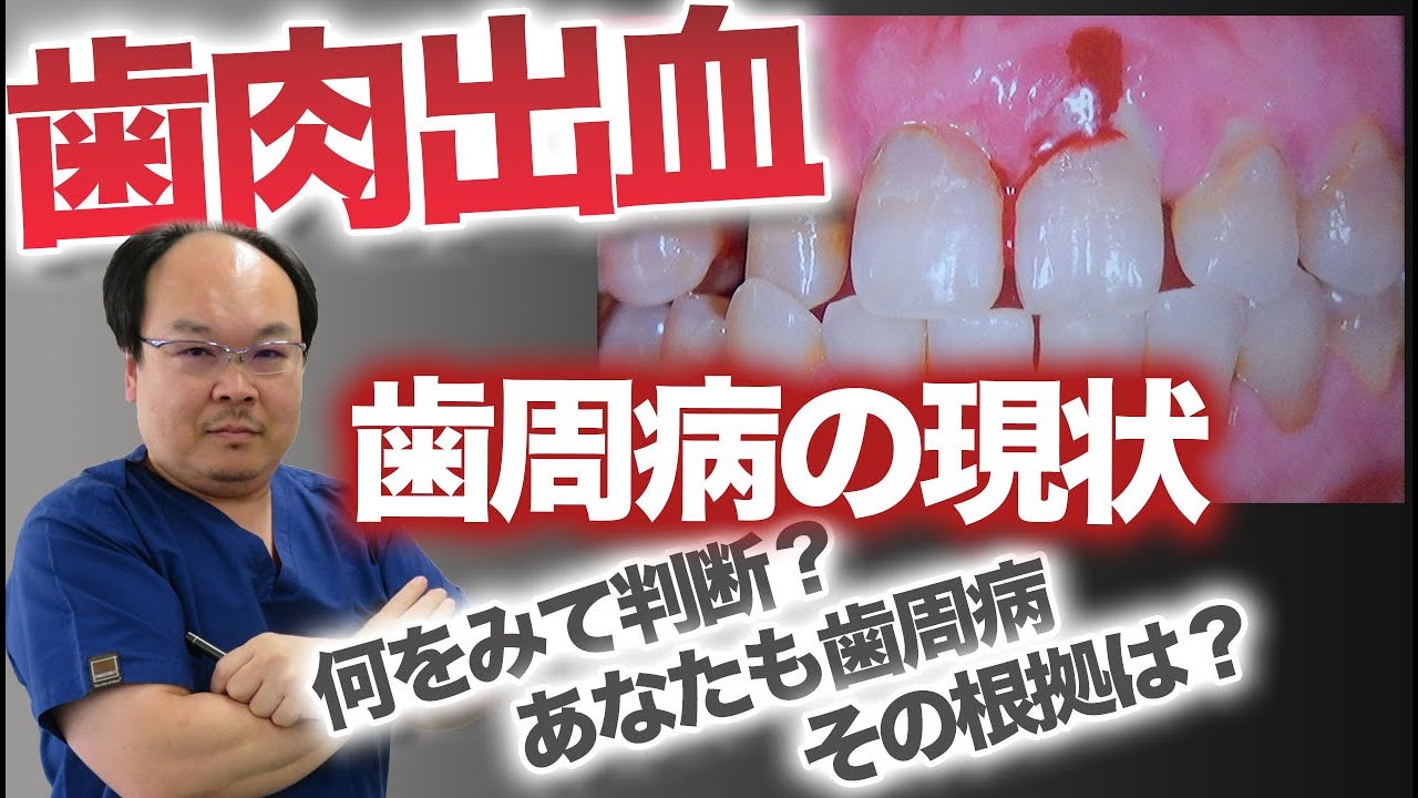 歯周病の現状　何をみて判断？あなたも歯周病その根拠は？【和歌山市　歯科】