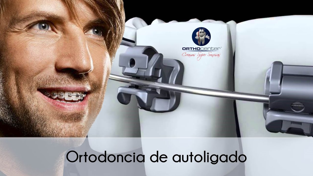 Ortodoncia de autoligado