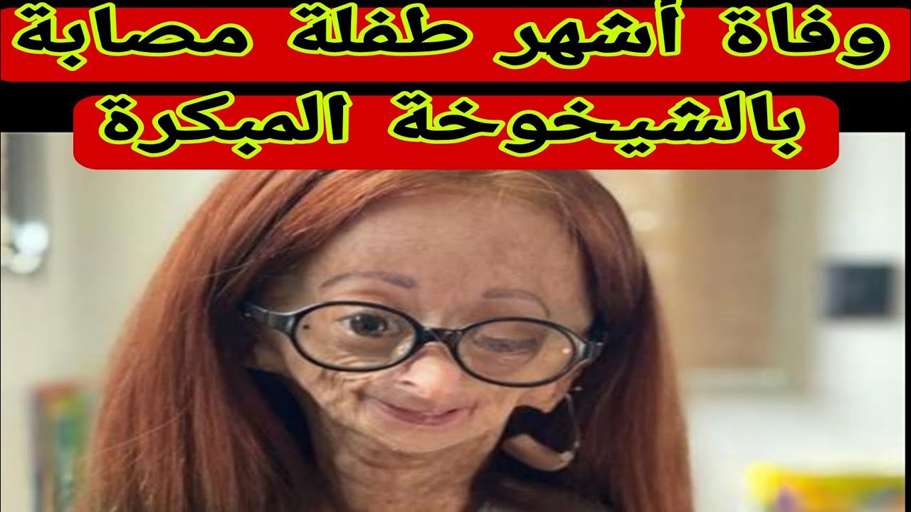 وفاة أداليا روز أشهر طفلة مصابة بالشيخوخة المبكرة
