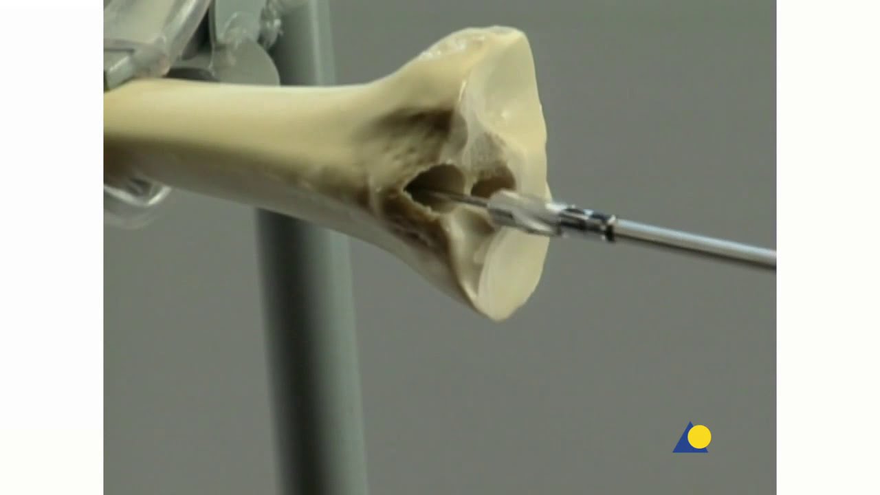 Tibia - Fractures - Enclouage Intra-Médullaire avec le Clou Tibial Expert (Avec Alésage)