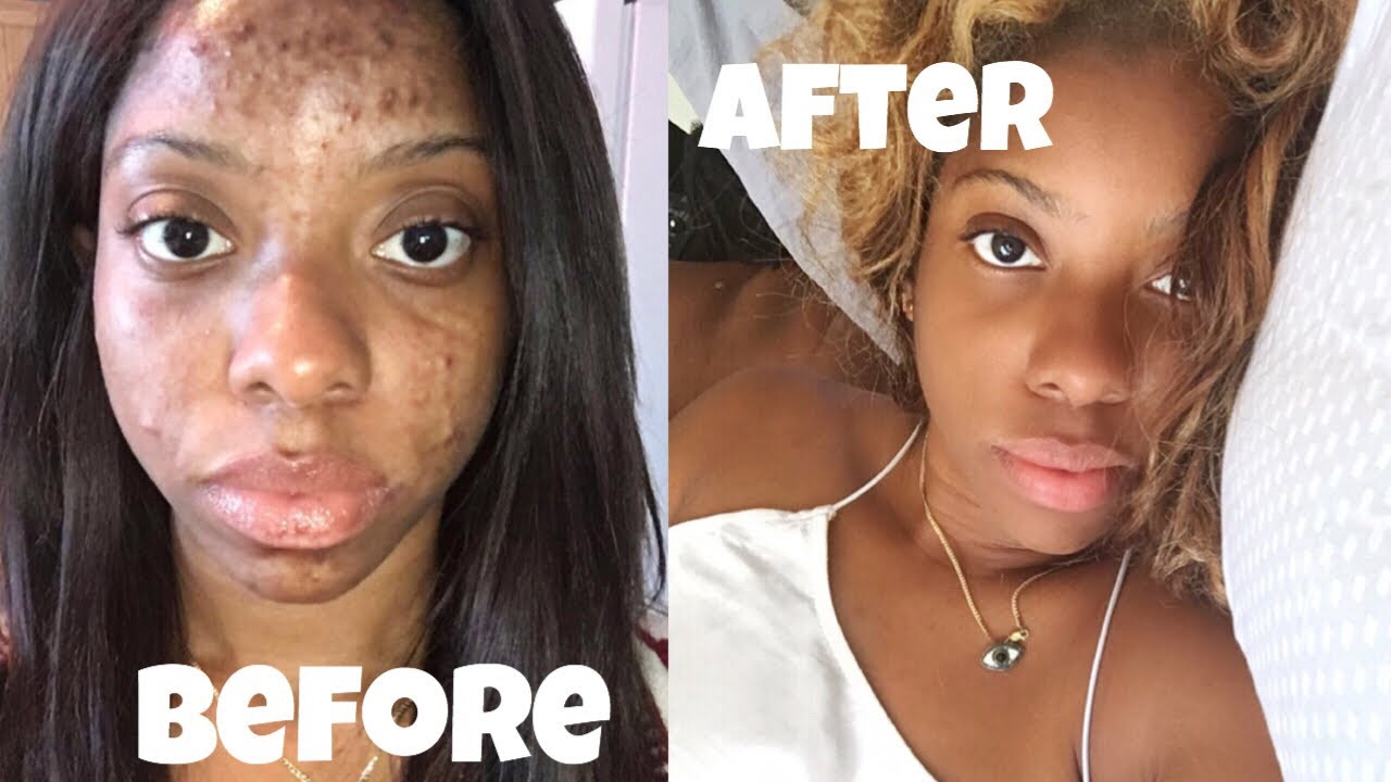 AFRICAN BLACK SOAP ✨ | HOW I CLEARED MY ACNE & DARK SPOTS!! W/ HAVING CHRON’S DISEASE