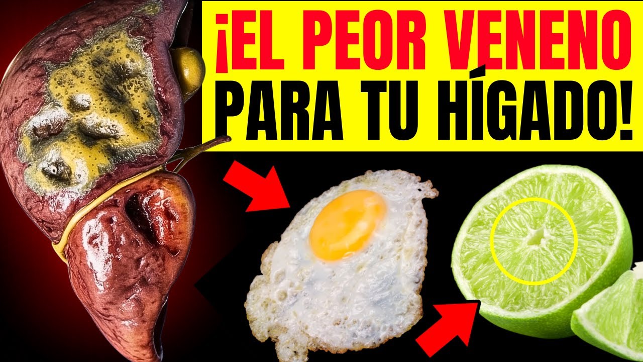 Los 17 PEORES Alimentos que Causan Esteatosis Hepática (Enfermedad del Hígado)