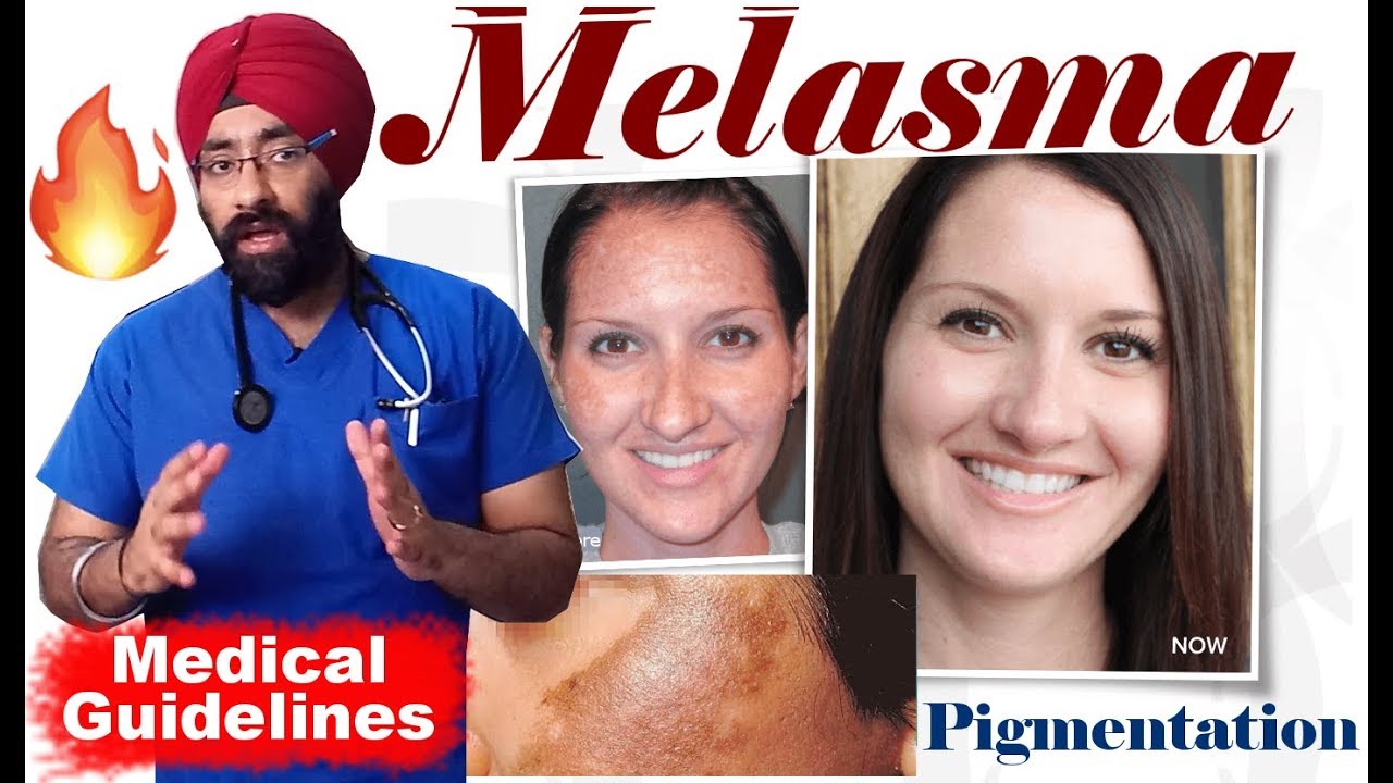 MELASMA | HYPERPIGMENTATION | DARK SPOTS : Permanent Cure Explained in ENG | Dr.Education + Bloopers