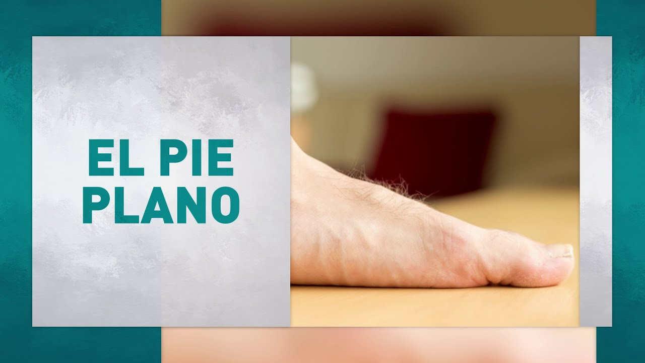 Pie plano. Conoce cómo identificar y tratar esta patología.