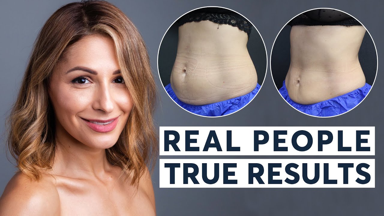 CoolSculpting & EmSculpt | Real People, True Results