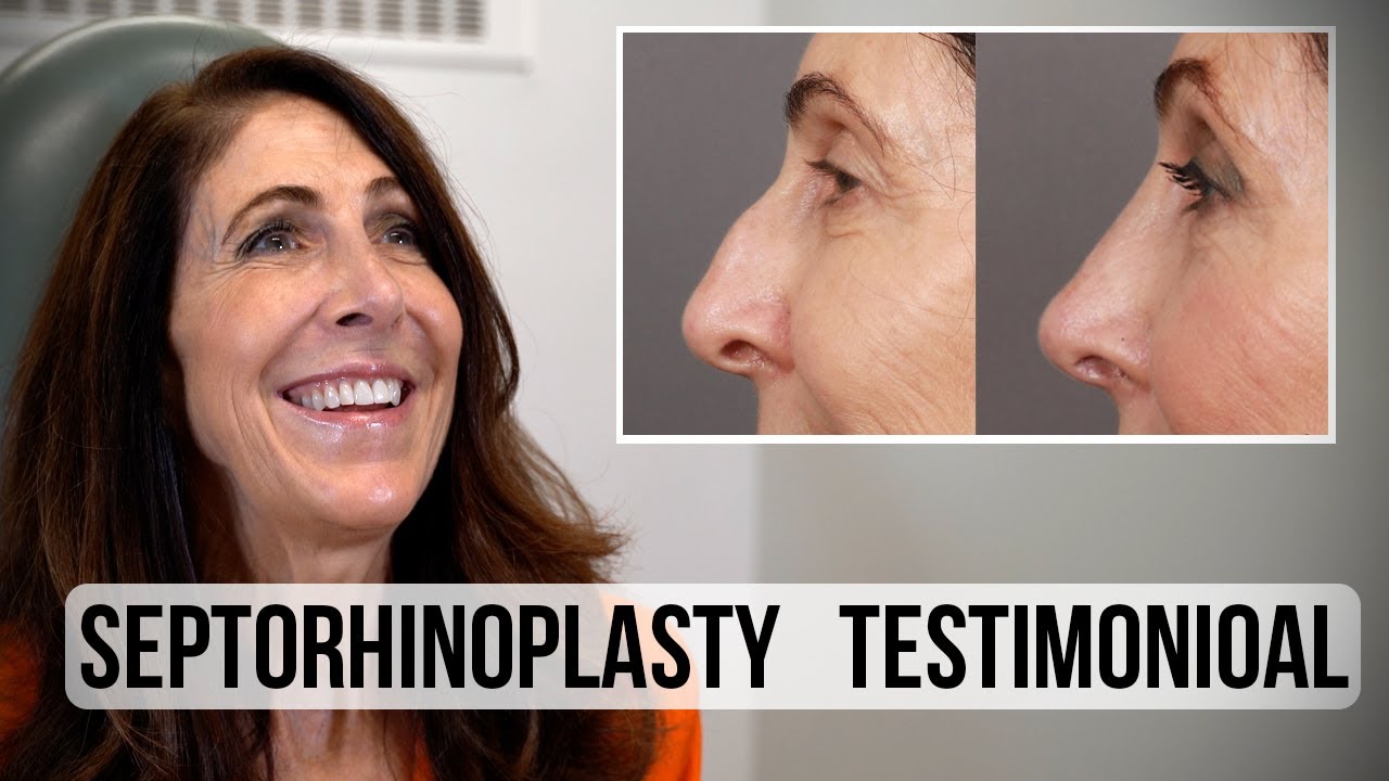 Septorhinoplasty (Nose Job) Patient Testimonial | West End Plastic Surgery