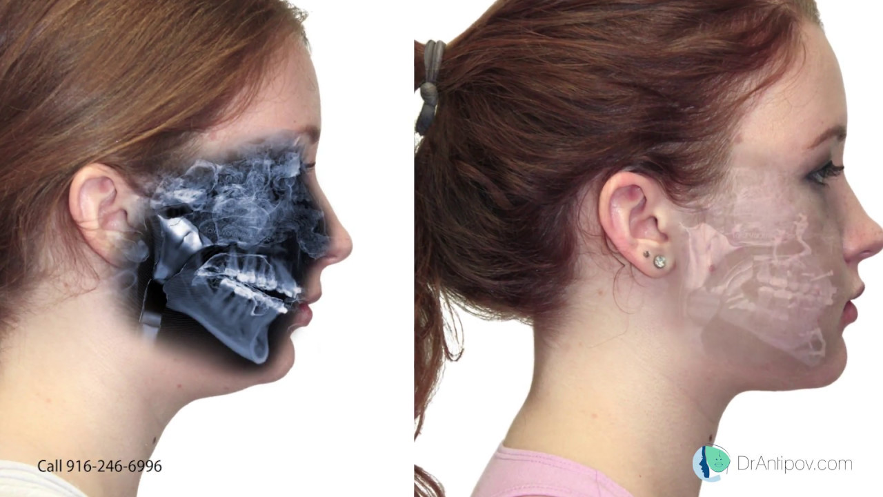 Face, Airway, and Bite Correction /   CASE 12