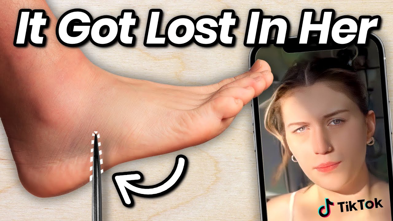 13-Year-Old Steps on Needle and Loses it. 10 Years Later, She Goes Viral on TikTok.