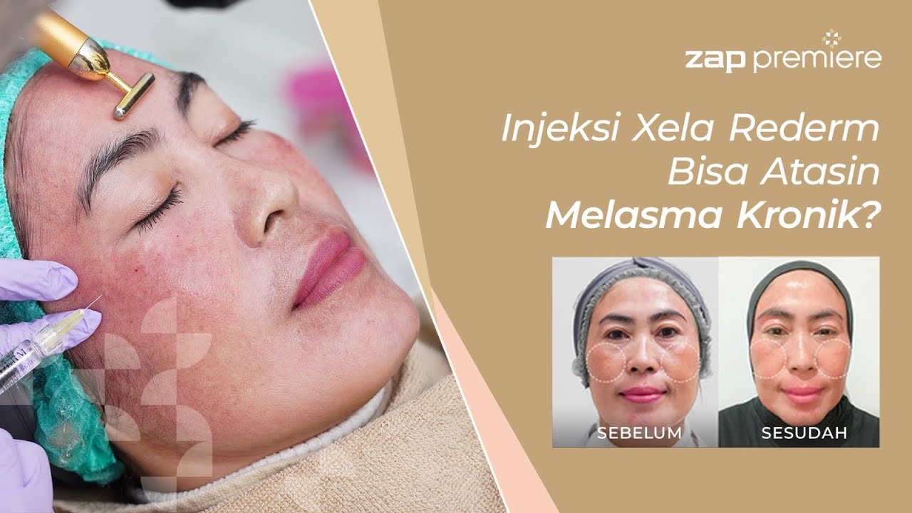 INJEKSI XELA REDERM BISA ATASIN MELASMA KRONIK! INI HASILNYA!