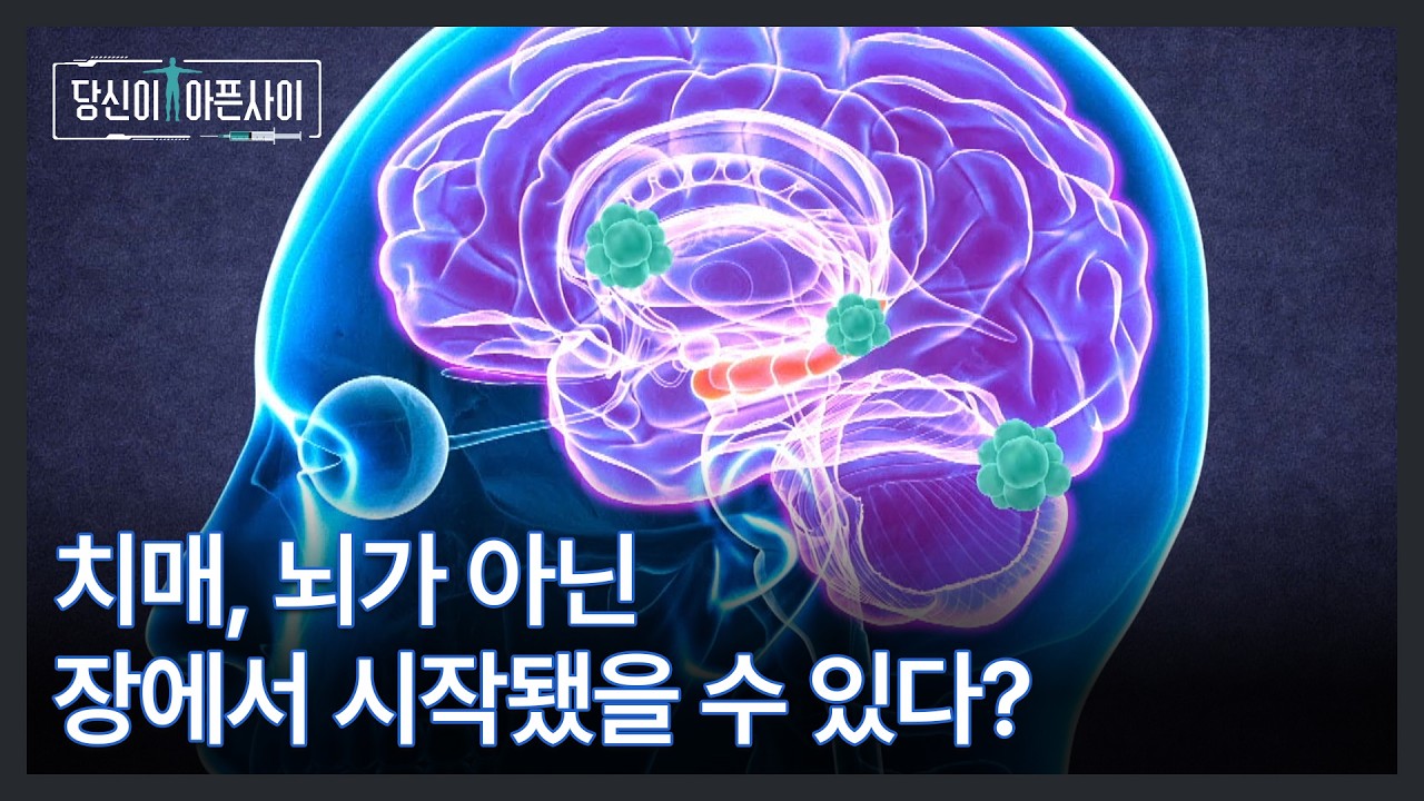 치매, 뇌가 아닌 장에서 시작됐을 수 있다? 뇌를 위협하는 장 곰팡이의 정체는? MBN 260201 방송
