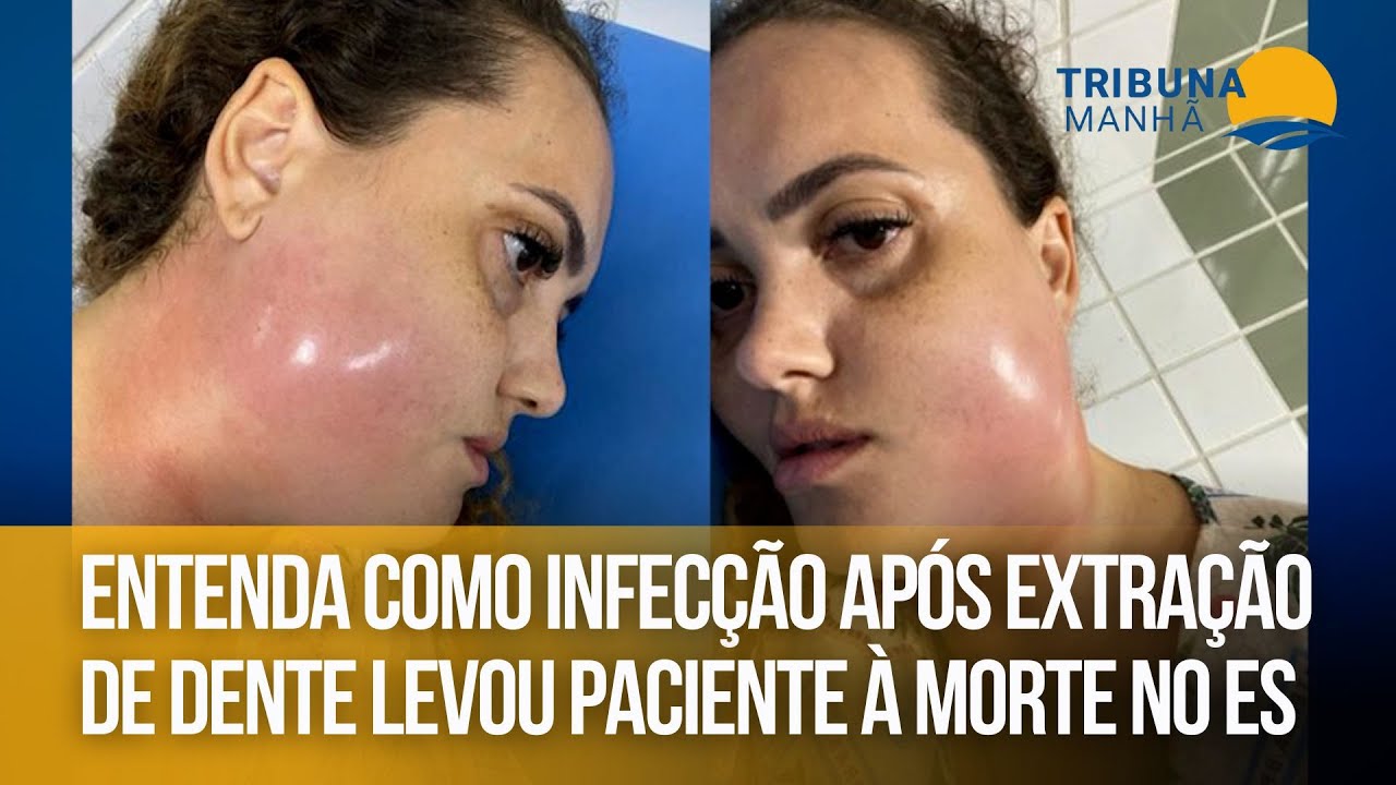Entenda como infecção após extração de dente levou paciente à morte no ES