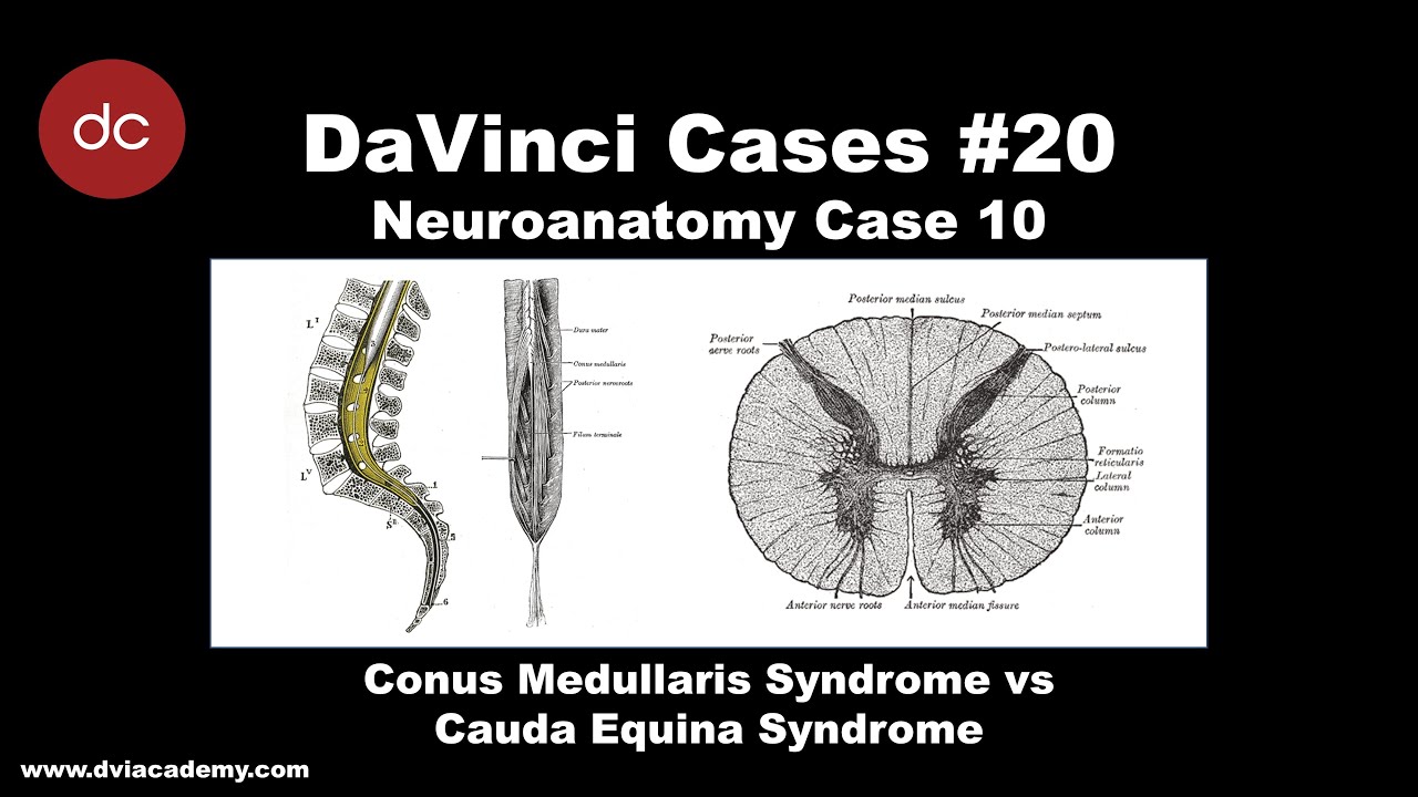 Conus Medullaris Syndrome vs Cauda Equina Syndrome Case [#DaVinciCases Neuroanatomy 10]