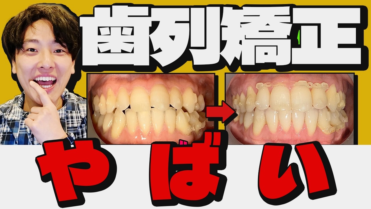 【しんどい？痛い？】1年3ヶ月間の歯列矯正体験【100万超え】