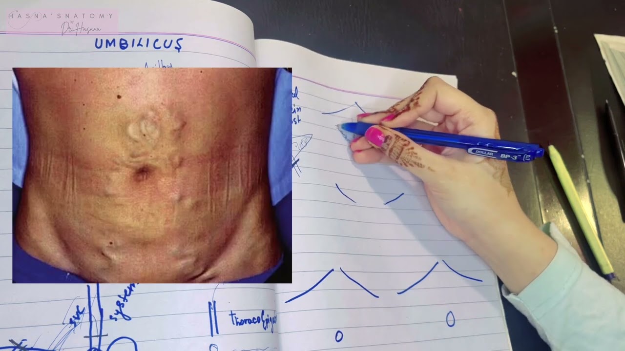 Umbilicus | Portocaval anastomoses | Caput Medusae | SVC IVC Obstruction | Watershed Line