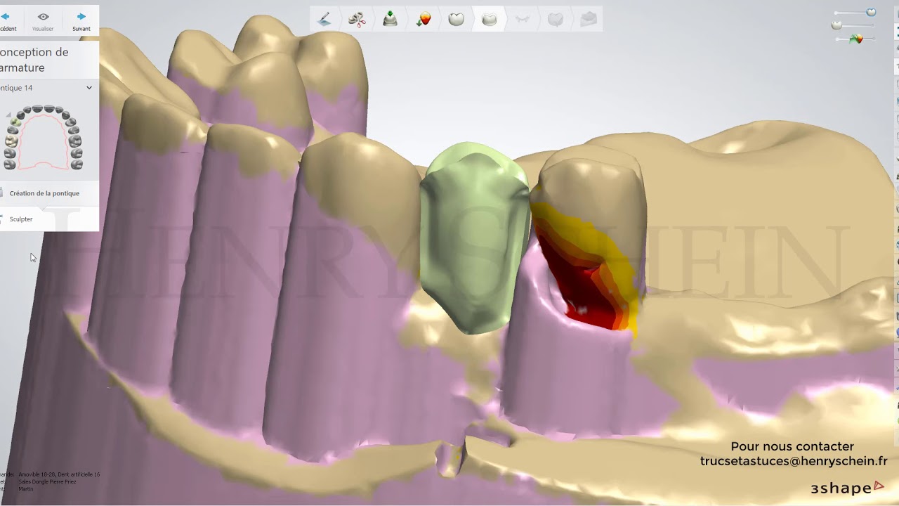 Stellite Dents massives et contre plaqu&eacute;es