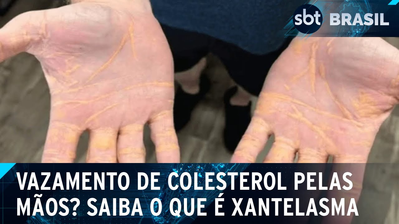 Entenda o que é xantelasma, condição que faz colesterol 