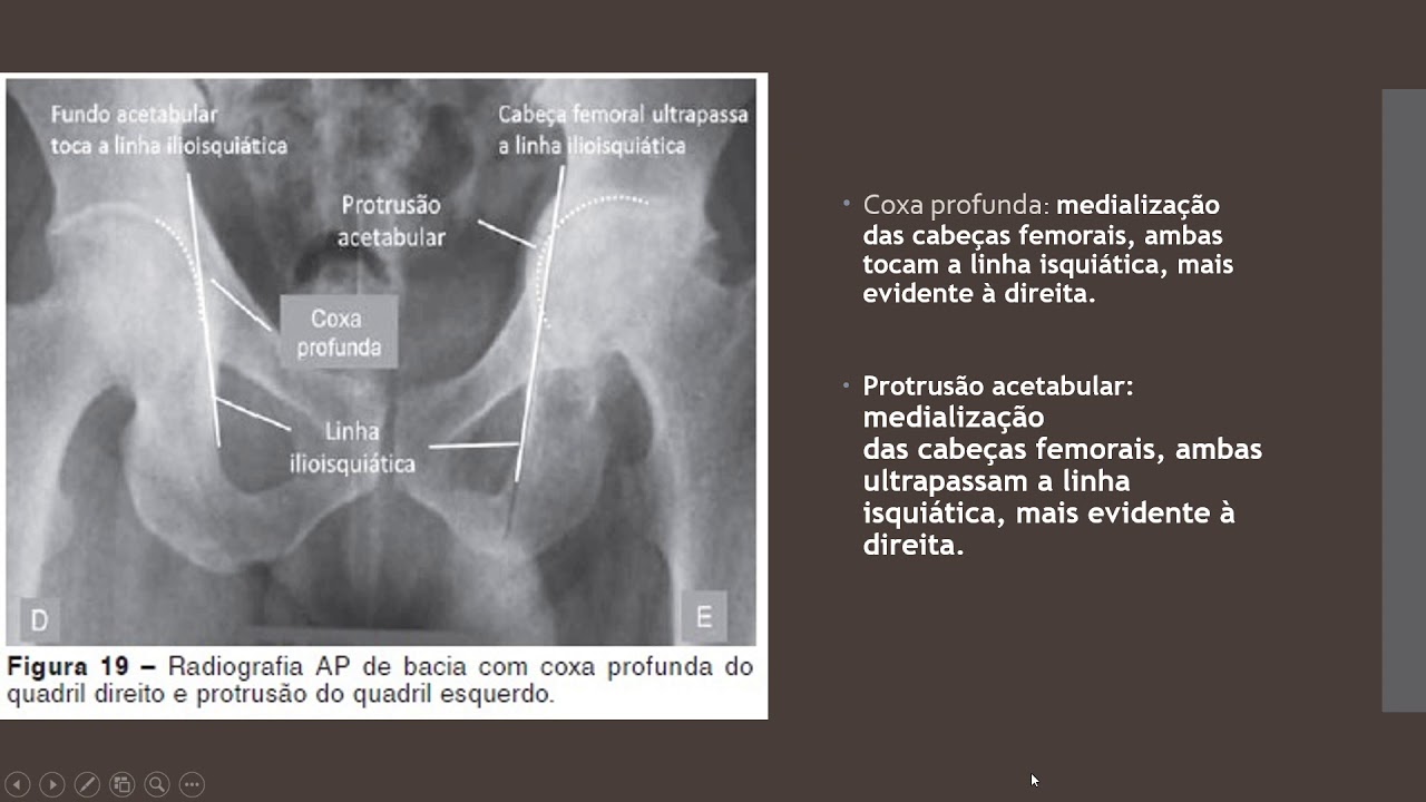 Radiografia de Bacia: o que avaliar. Resumão