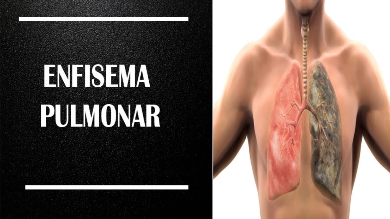 Enfisema Pulmonar Enfermagem Educacional