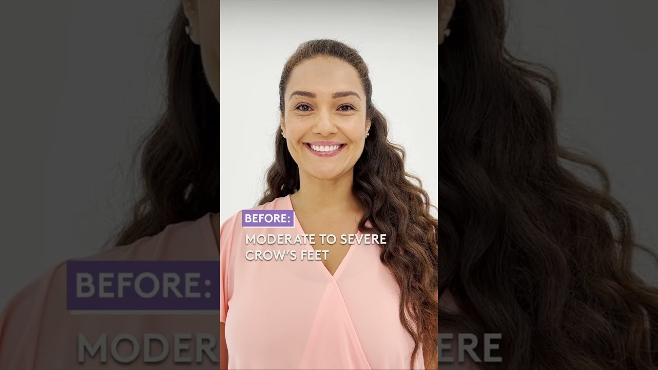 Botox Injections Before and After - Botox Near Me