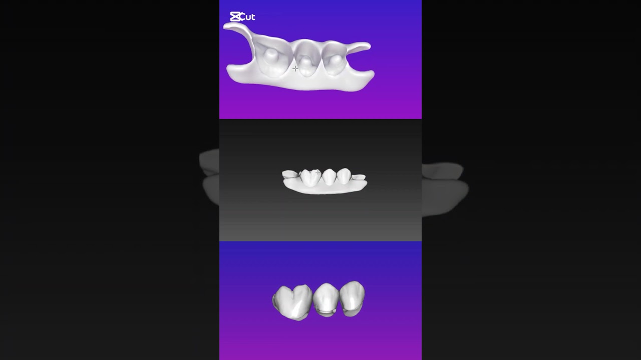 Flipper on Exocad 🦷🔥#exocad #cfao #cao #cadcam #prothesedentaire #conception #edit