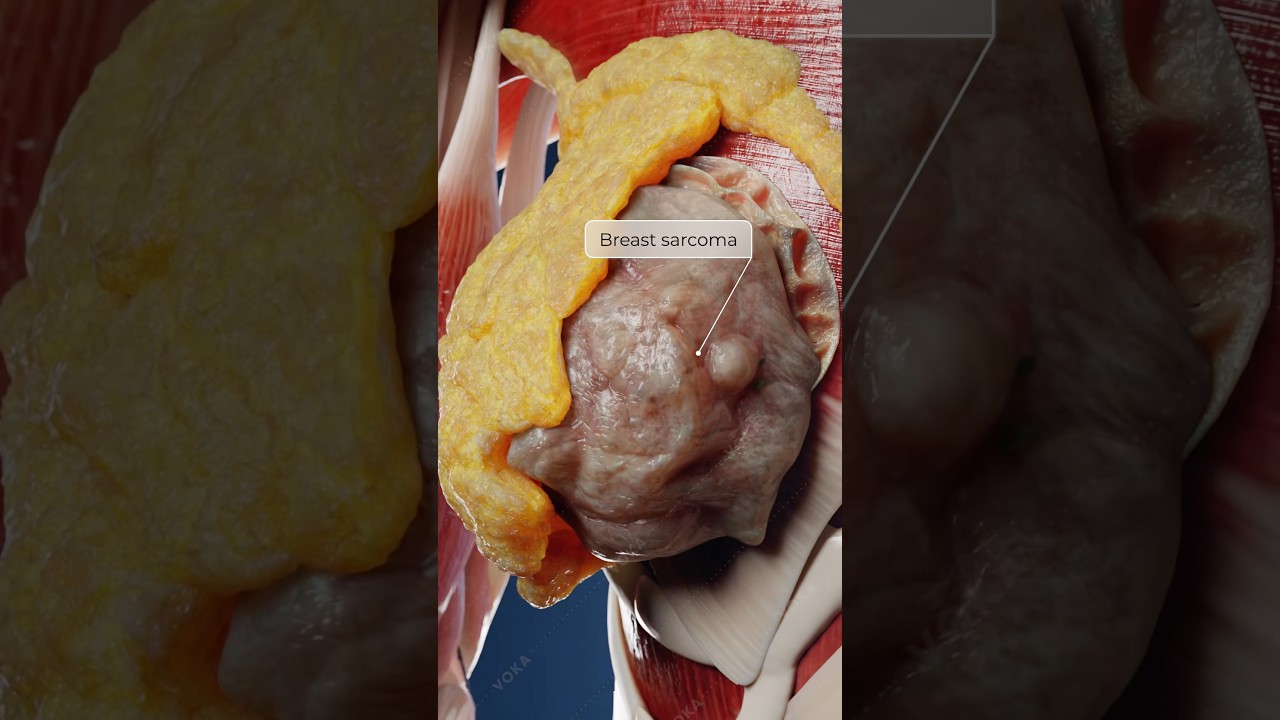 The Fast-Growing Breast Cancer You Should Know About: Breast Sarcoma in 3D