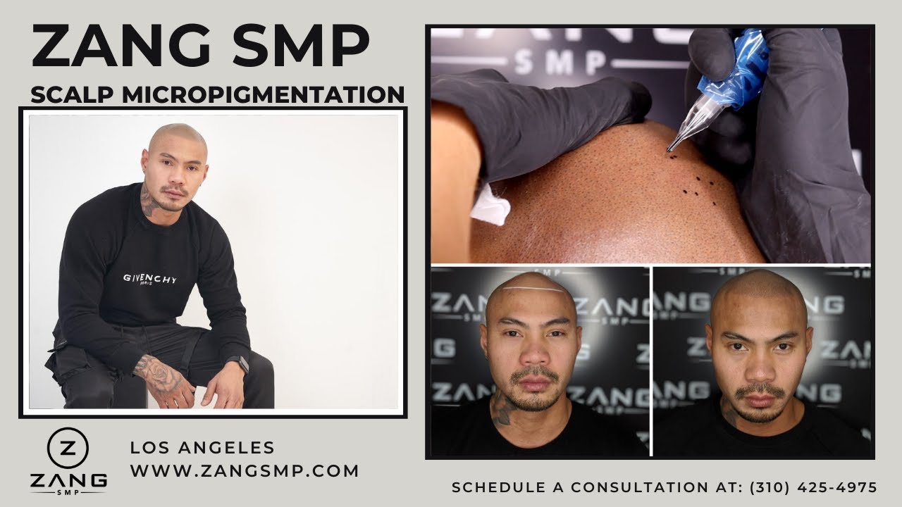 Scalp Micropigmentation Los Angeles - Zang SMP - Dennis