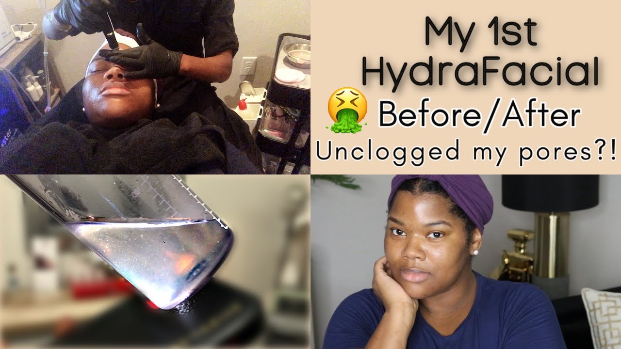 My First HydraFacial Treatment - Review, Results, Before & After |  for Black Skin, Acne, Anti Aging