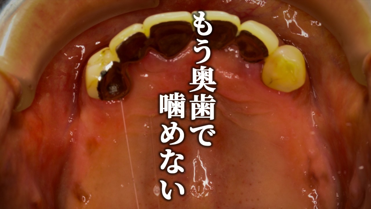 歯が無い第二の人生はイヤ！食の悦びを奪還せよ