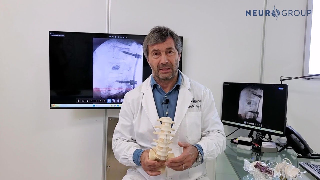 DOTT. MASSIMILIANO NERONI - Fratture vertebrali
