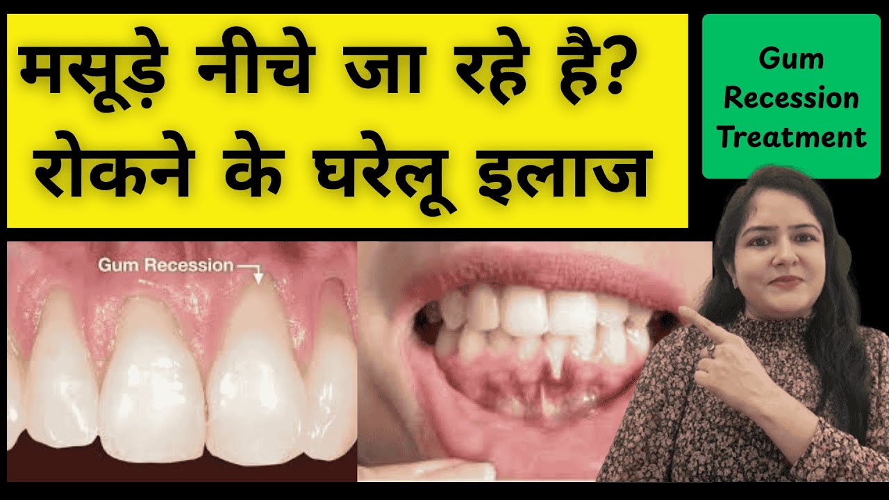 मसूड़े नीचे जा रहे है रोकने के घरेलू इलाज | Home Remedies For Gum Recession. #dentalcare 