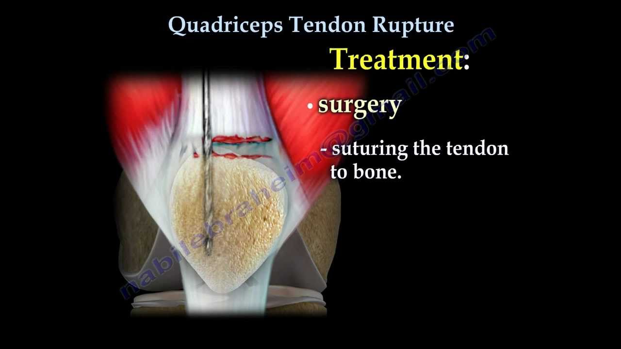 Quadriceps Tendon Rupture - Everything You Need To Know - Nabil Ebraheim
