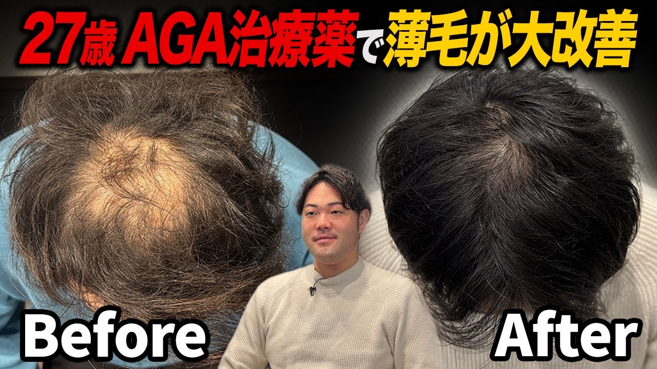 【劇的変化】AGA治療を10ヶ月続けた20代メンズのリアル結果