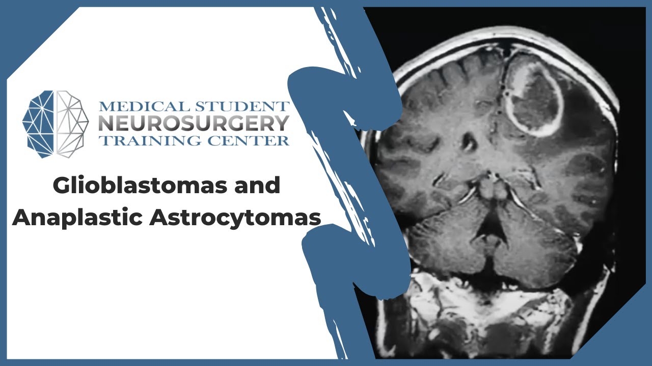Glioblastomas and Anaplastic Astrocytomas