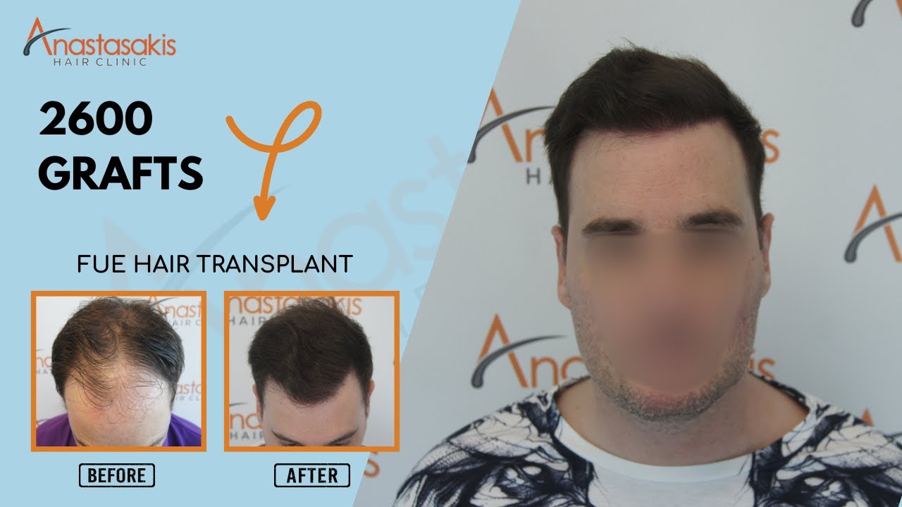 Case #310: Γιώργος 11 Μήνες Μετά τη Μεταμόσχευση Μαλλιών με FUE στην Anastasakis Hair Clinic! 💇‍♂️✨