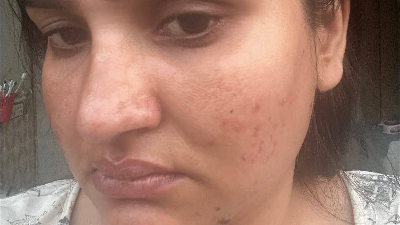 PM Skincare Routine | Azelaic Acid + Niacinamide + Alpha Arbutin