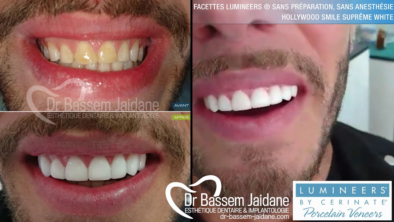 Facettes LUMINEERS ® sans préparation en Tunisie