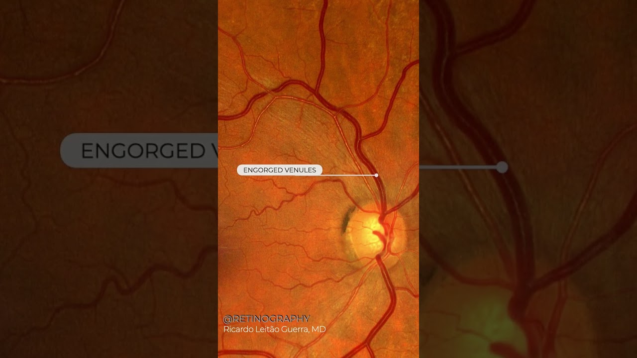 Hypertensive retinopathy #retina #oftalmo #ophthalmology #oftalmologia #oftalmolog&iacute;a #ophtalmologi