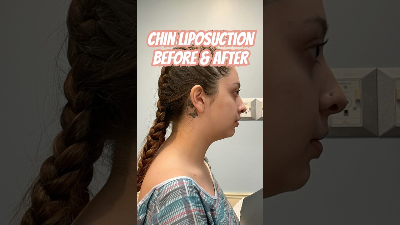 Mariah&rsquo;s Chin Lipo Results ✨ Double Chin Gone at Adonis Plastic Surgery (Torrance, CA)