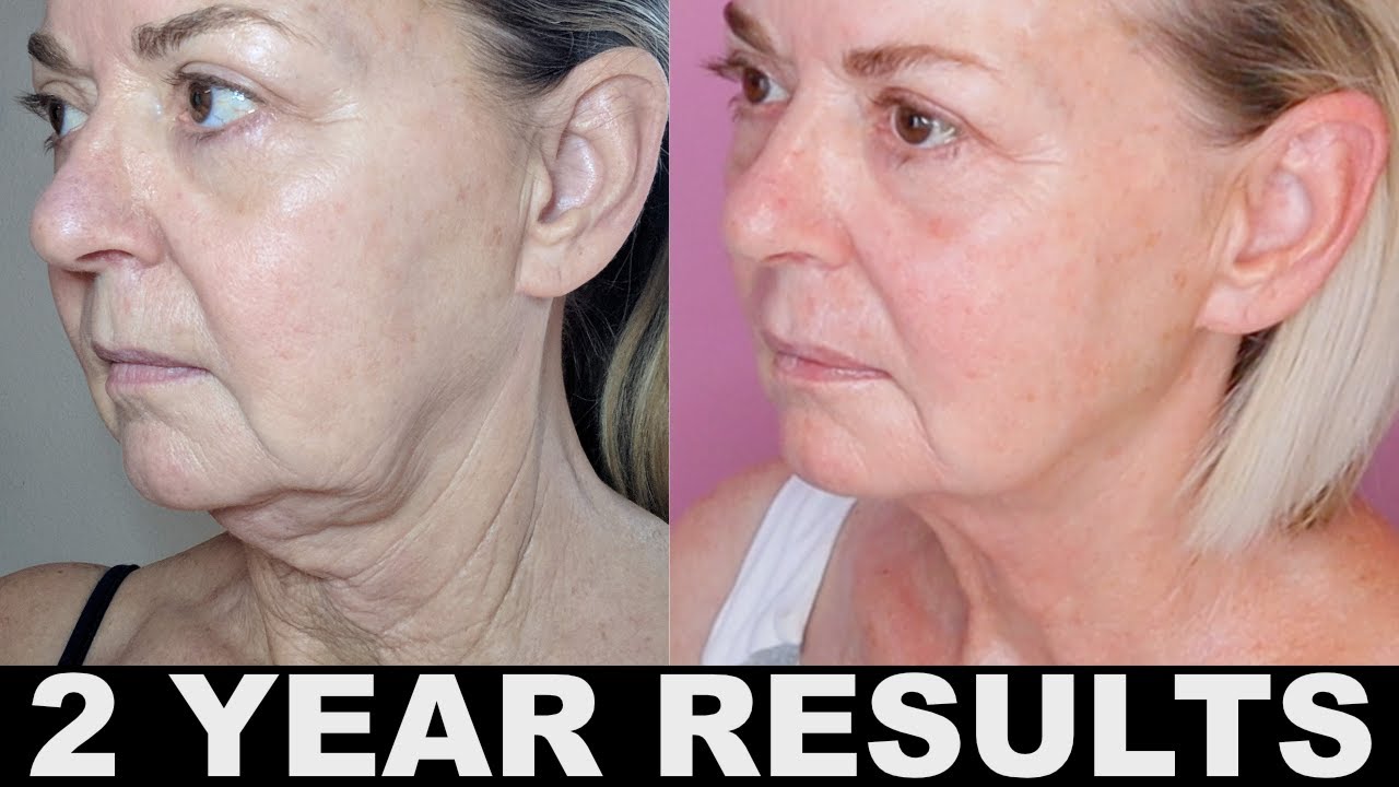 2 Year Anti-Aging Skincare Results Over 50 - Tighter, Firmer Skin