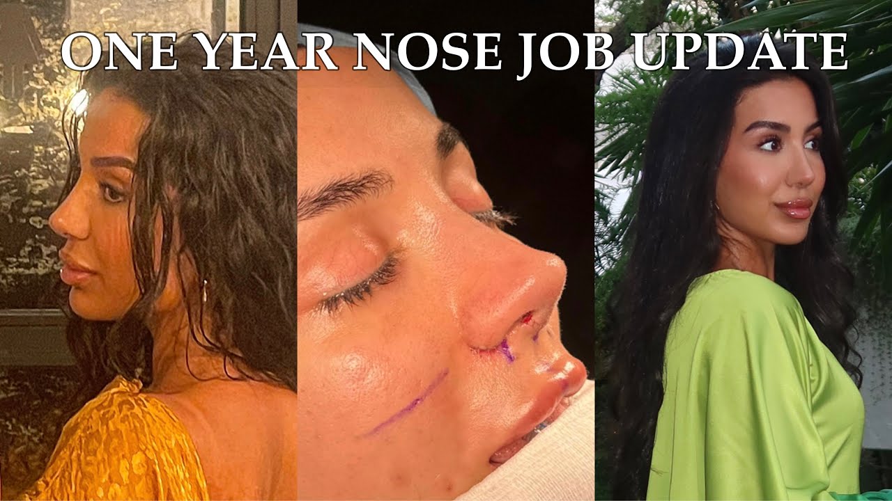 1 year Nose Job update | Q&A