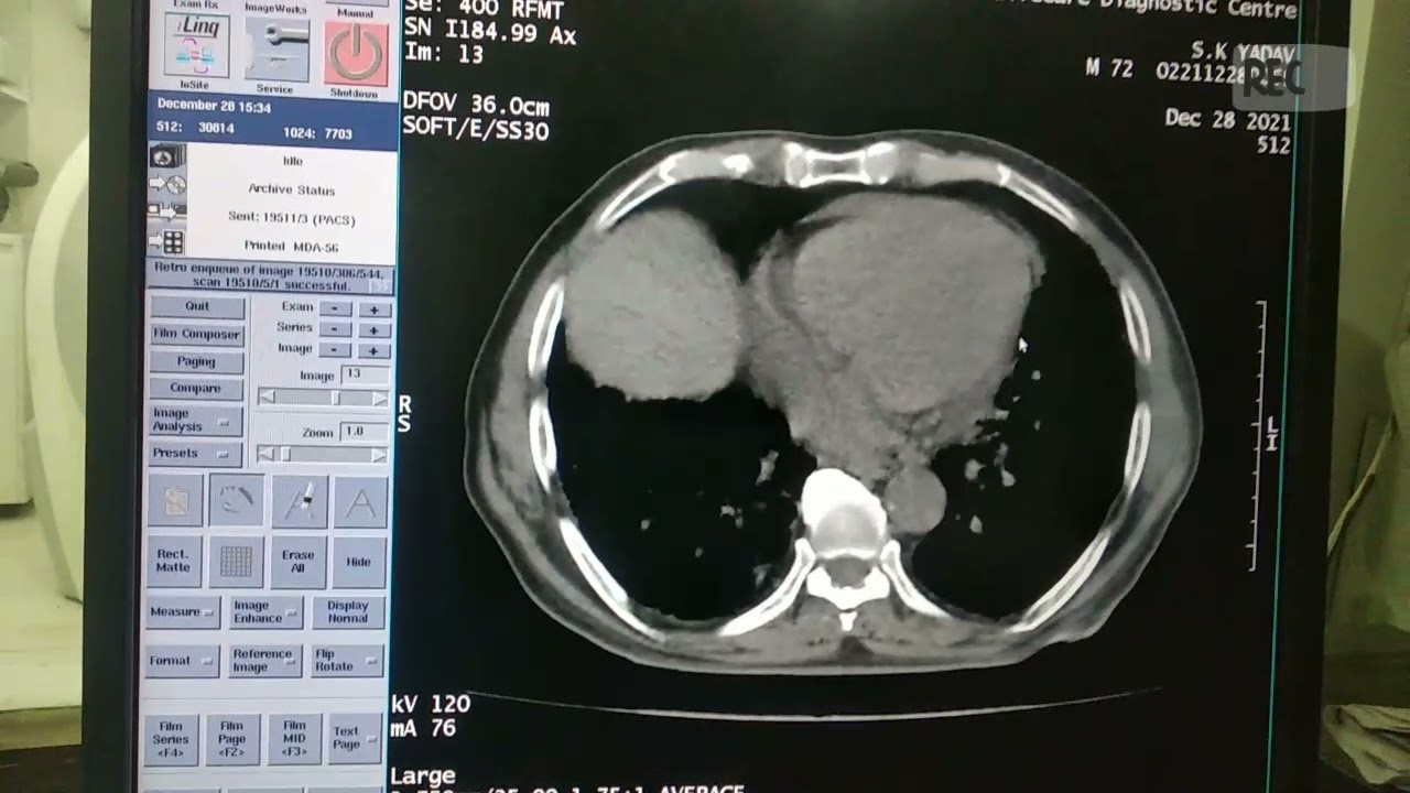 FILMING OF CT SCAN THORAX WITH CONTRAST