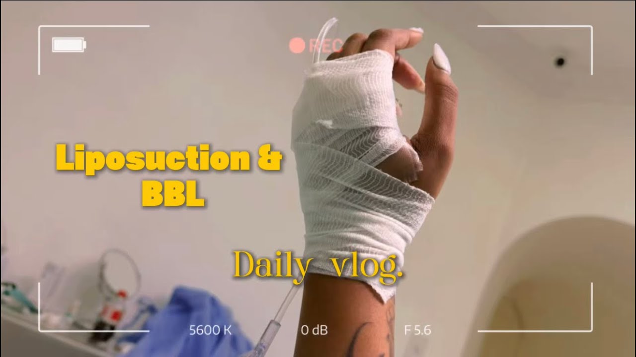 Liquid BBL & 360 liposuction Surgery 