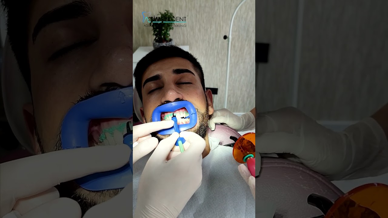 Diş Taşı Temizliği ve Diş Beyazlatma