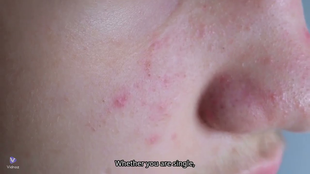 Skincare Routine for Women with Acne-Prone Skin in the UAE and Saudi Arabia